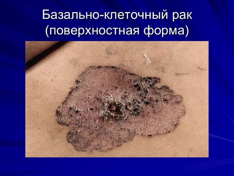 Базально-клеточный рак (поверхностная форма)